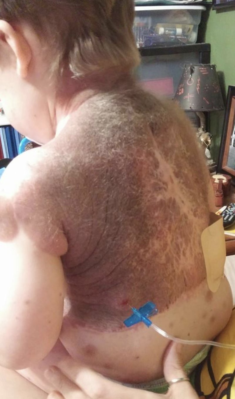 80 procent av Dylans kropp var täckt av födelsemärken. Bildkälla: Facebook/Dylan's Amazing Journey 80 procent av Dylans kropp var täckt av födelsemärken. Bildkälla: Facebook/Dylan's Amazing Journey